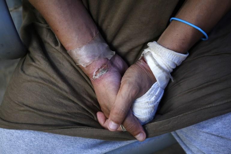 A Palestinian detainee shows injuries to his hands after being released by the Israeli army into Gaza on June 20, 2024. The man had been detained during an Israeli attack on the Gaza Strip. The Palestinians who were released east of the city in the central Gaza Strip were seen to be weakened and had scars on their bodies [Ashraf Amra/Anadolu via Getty Images]